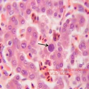 Hepatitis por cuerpo de inclusión: características e impacto de la enfermedad
